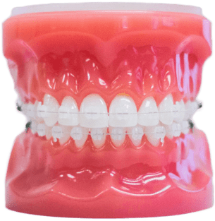 clear braces on plastic model