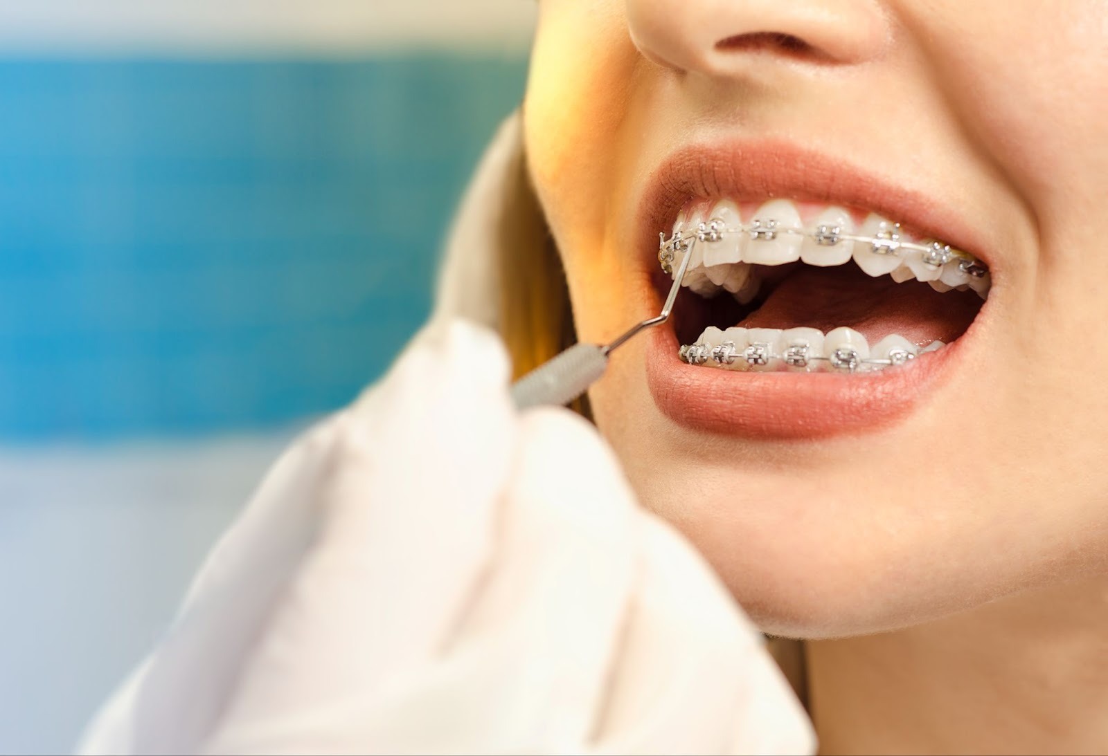 Are Metal Braces Still a Good Option?