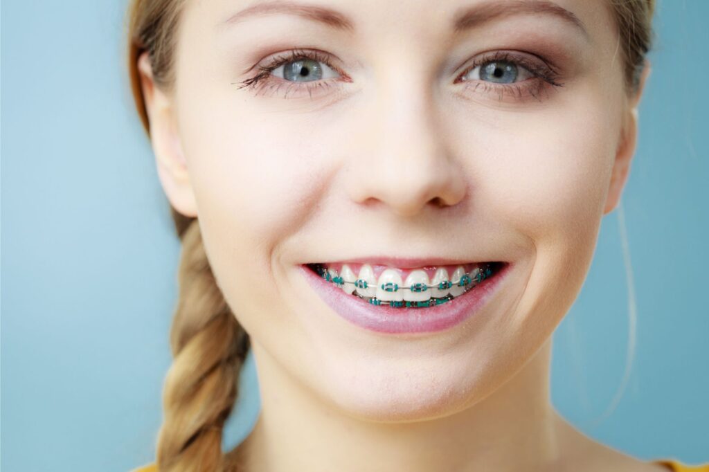 How Long Do Braces Take?