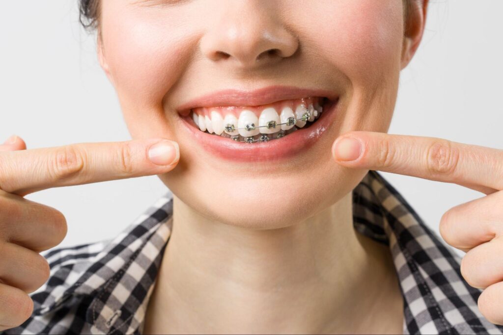 How Long Do Braces Take?